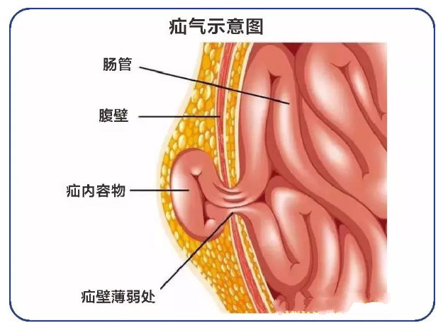 勿以疝小而不为一例奇葩的嵌顿疝